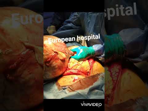 اسئصال ورم وزنه 14 ك جرام بنجاح فى المستشفى الاوروبي بشبين الكوم