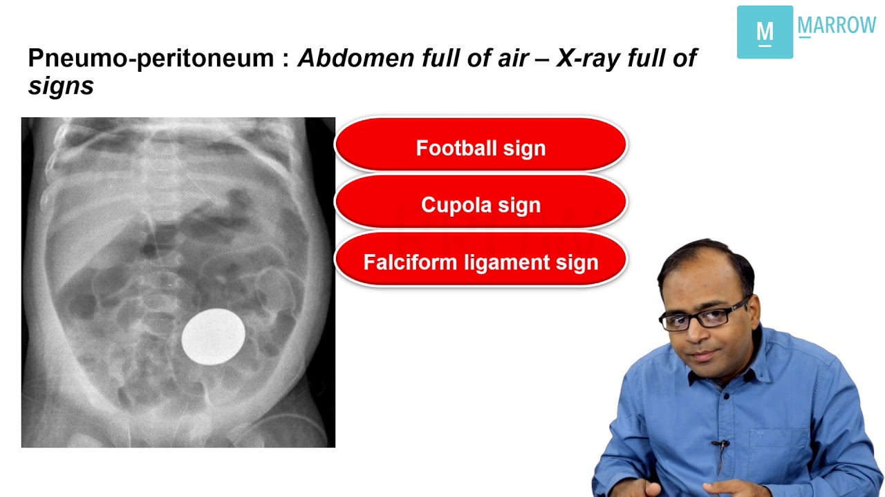 CONCEPTUAL RADIOLOGY ON MARROW X ray signs in pneumoperitoneum YouTube