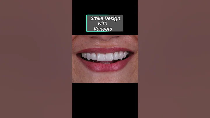 Smile Design with Veneers Watch the Stunning Before & After Dental Transformation #smiledesigndental
