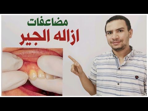 بعد ازاله الجير اصبحت اسناني تتحرك من مكانها