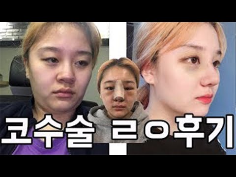 다시 태어났습니다...일주일간의 <strong>복코</strong> <strong>수술</strong> ㄹㅇ후기