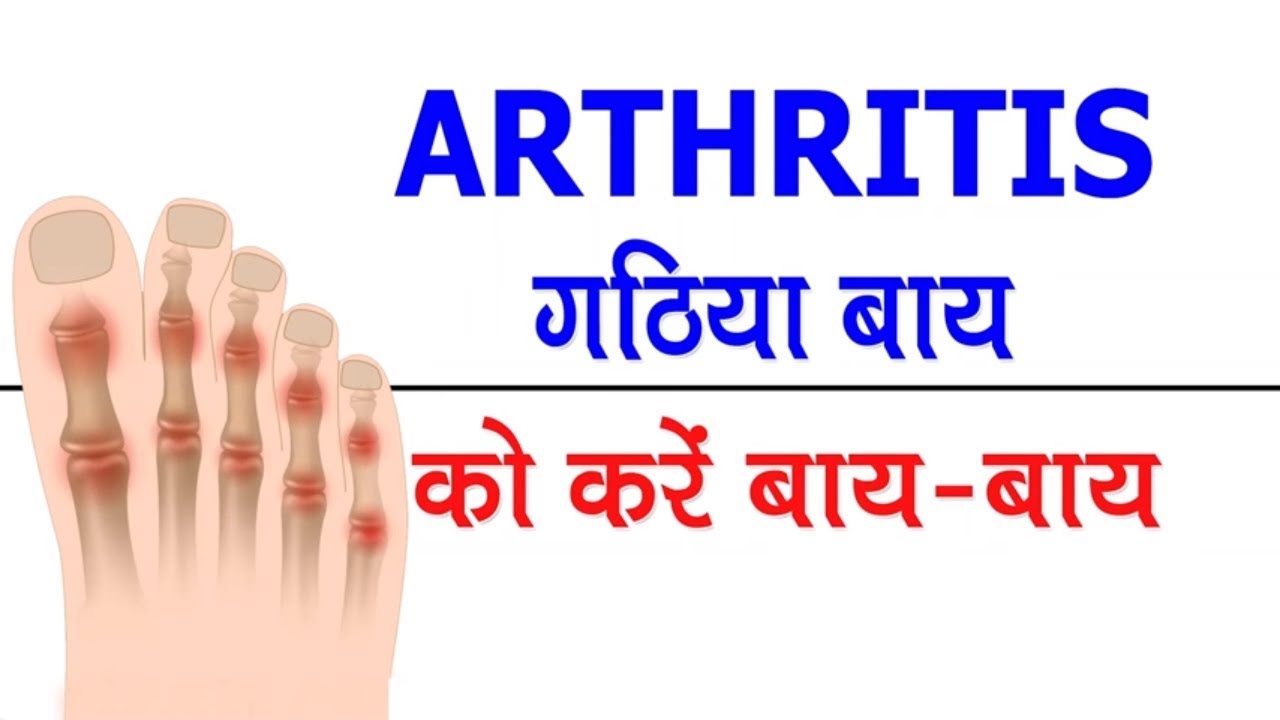 Best Arthritis Treatment in Hindi - गठिया बाय को कहें बाय बाय - Home