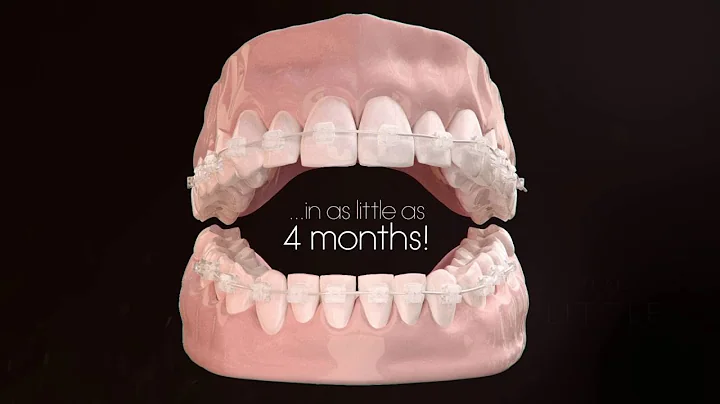 Dr Gregory Flint Cfast Orthodontics - LINGUAL