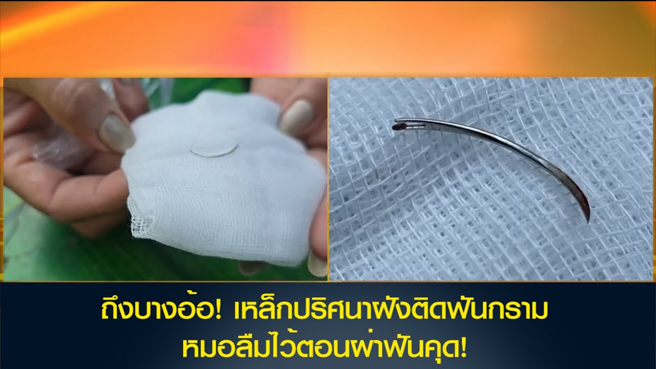 ถึงบางอ้อ! เหล็กปริศนาฝังติดฟันกรามหมอลืมไว้ตอนผ่าฟันคุด