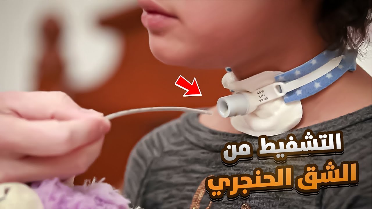 مهارات التمريض | (17) ليه الـ Foley Catheter قسطرة فولي الآمن للتشفيط من Tracheostomy الشق الحنجري؟