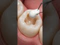 Severely Decayed Molar 😱 | What Happens If You Ignore Cavities?