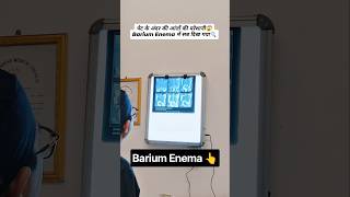 Early detection of polyps, inflammation, or structural blockages using the Barium Enema procedure.