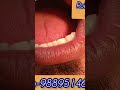 दांतों के बीच वाली जगह कैसे सही करते हैं #dentalclinic #dentalartistry #dentalcare