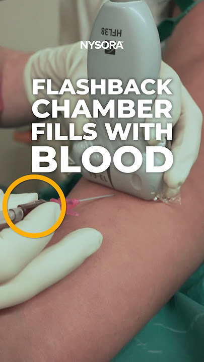 Challenging IV Case - Ultrasound-Guided Technique #ivaccess #ultrasound #nurse #veins #iv