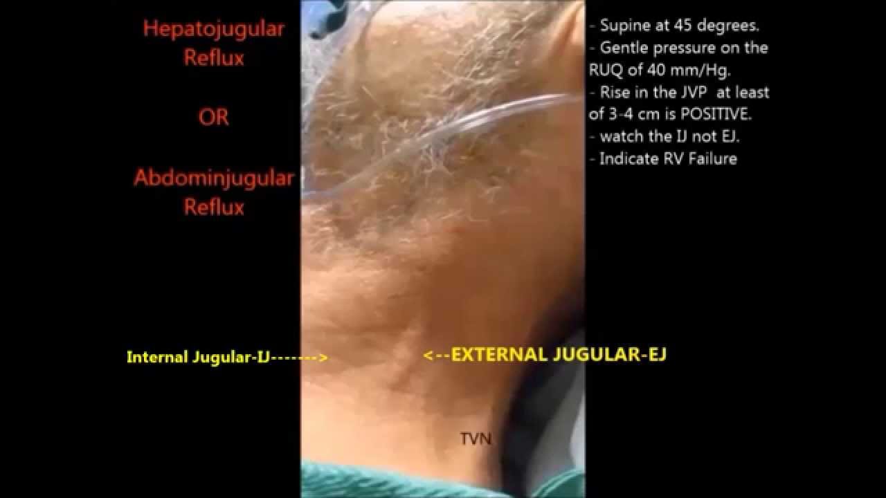 a test report blood Reflux of heart a sign congestive Hepatojugular Right