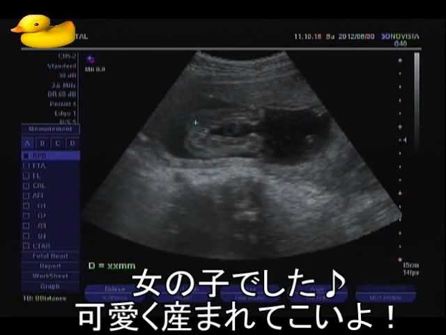 妊娠19週4日エコー動画 19w4d Echo Video Pregnancy Youtube