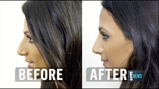 Dr Raj Kanodia Talks Scarless Rhinoplasty on E! News Net Worth