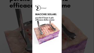 Macchie solari: perché il laser è più efficace delle creme