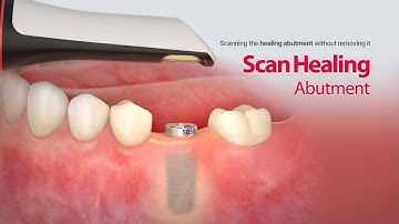 Able to scans the healing abutment without removing it : “Scan Healing Abutment”
