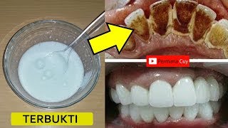 Dalam 1 Hari Gigi Kuning Menjadi Putih | Pemutihan Gigi Di Rumah