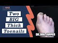 Two Big Thick Toenails.  Is this Fungal Nails? [Dr Nail Nipper] (2020)