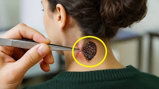 Doktor Bunun Sıradan Bir Sivilce Olduğunu Düşündü. Ama Cildinin Altında Büyüdüğünü Görünce Bağırdı