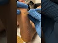 Ultimate Callus Removal Satisfaction Thick Forefoot Transformation by Podiatrist
