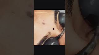 Laser Tattoo Removal ? | viral shorts lasertreatment  cosmeticsurgeon
