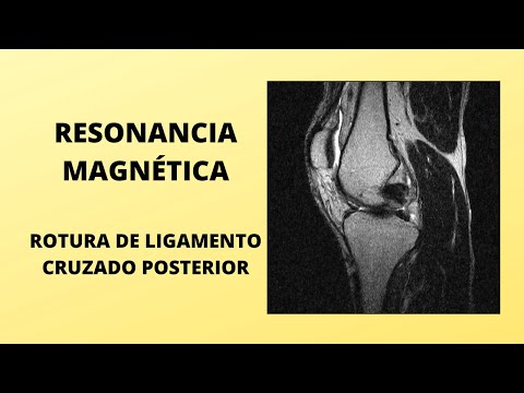 Video: ¿Una resonancia magnética mostrará un cordón anclado?