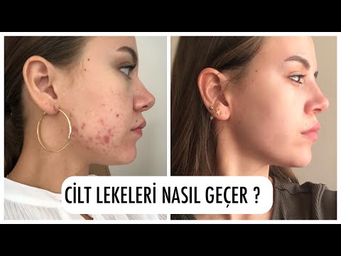 SİVİLCE İZLERİ VE LEKELERİ NASIL GEÇER 🧐 CİLDİ PARLAK GÖSTEREN KREM