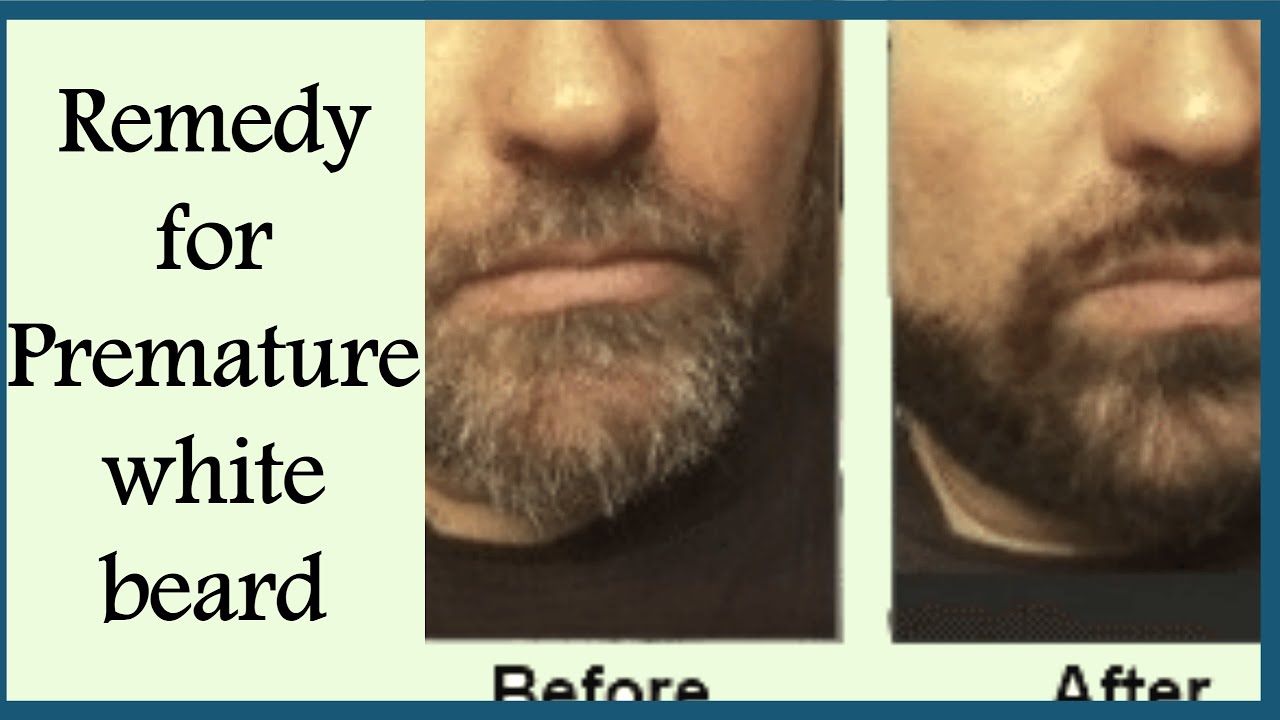 Magical Remedies For PREMATURE GREY BEARD Remove WHITE HAIRS On