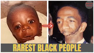 13 Rare Black Individuals With Unique Features You Won’t Believe Exist | Hollywood Revealed