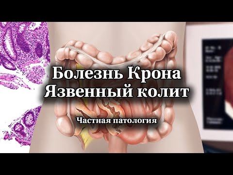 Болезнь Крона и язвенный колит | Частная патология