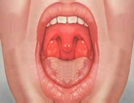 Acid reflux symptoms in throat