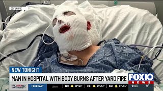 Mobile man recovering from severe burns after yard work fire