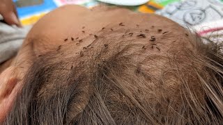 Remove head lice from brown hair - Getting out all head lice from head