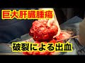 破裂した巨大肝臓腫瘍（腹腔内出血）