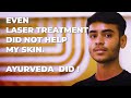 Laser treatment patient reviews dr nitika kohli