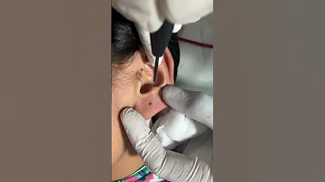 क न म छ द Ear Piercing Without Pain Painless Earlobes Piercing Skinaa Clinic Shortsfeed 
