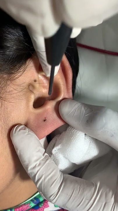 कान में छेद | Ear Piercing without Pain | Painless Earlobes Piercing | Skinaa Clinic #shortsfeed