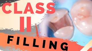 Class Ii Composite Restoration | Live Tooth Filling W/ Microscope