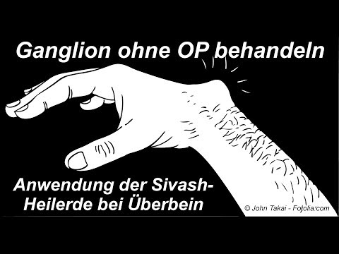 Natūralus ganglion cistos gydymas SIVASH – gydomojo jūros dumblo aplikacijomis be operacijos.