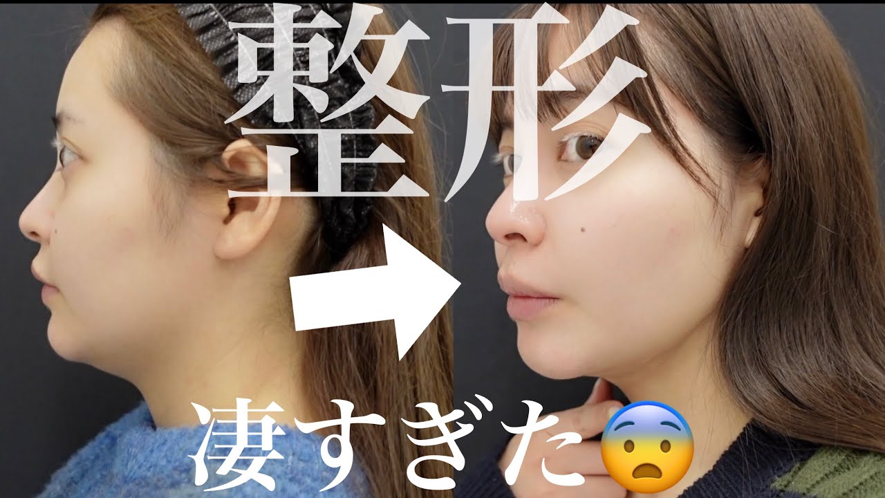 【脂肪吸引レポ】〜二重顎がなくなるまで〜【整形】