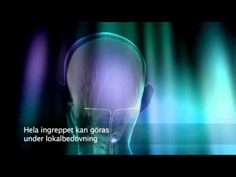 Video: Kronisk Migrän Och Depression: Vad är Länken