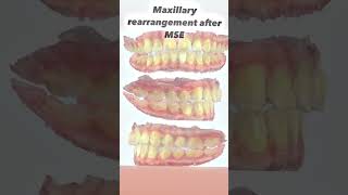 MSE space closure with Invisalign #marpe #mse #airway #airwaymanagement #florida