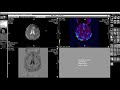 Обучающее видео «Перфузия МРТ Т2»