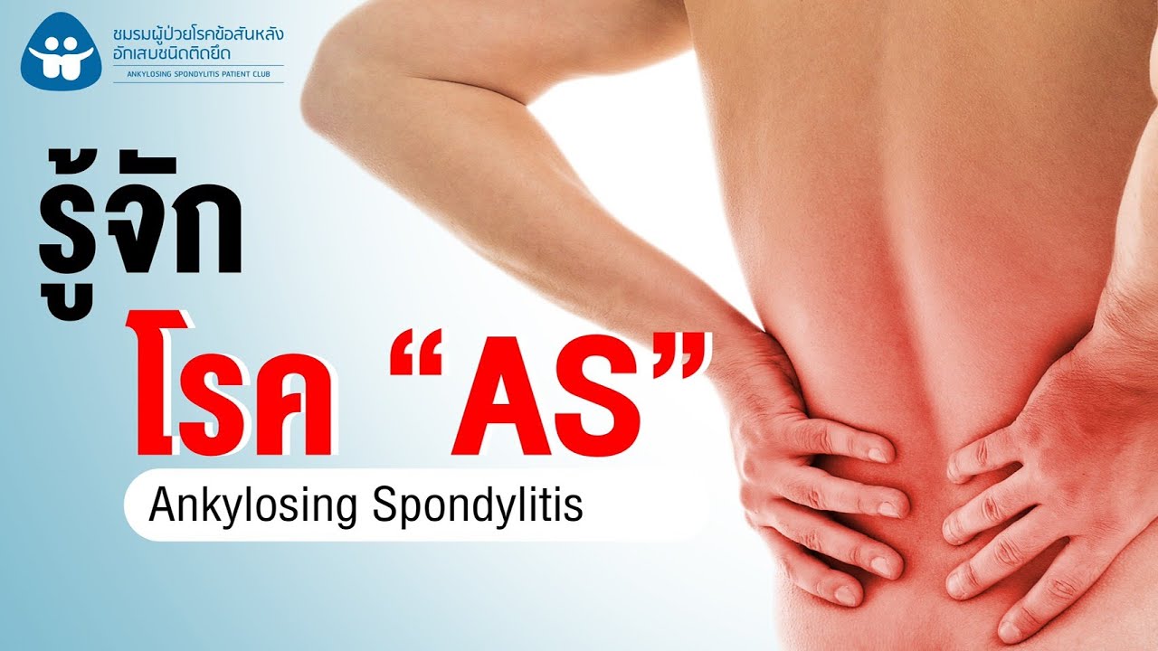 โรค AS (Ankylosing Spondylitis) หรือ โรคข้อกระดูกสันหลังอักเสบยึดติด คืออะไร สาเหตุ และอาการของโรค