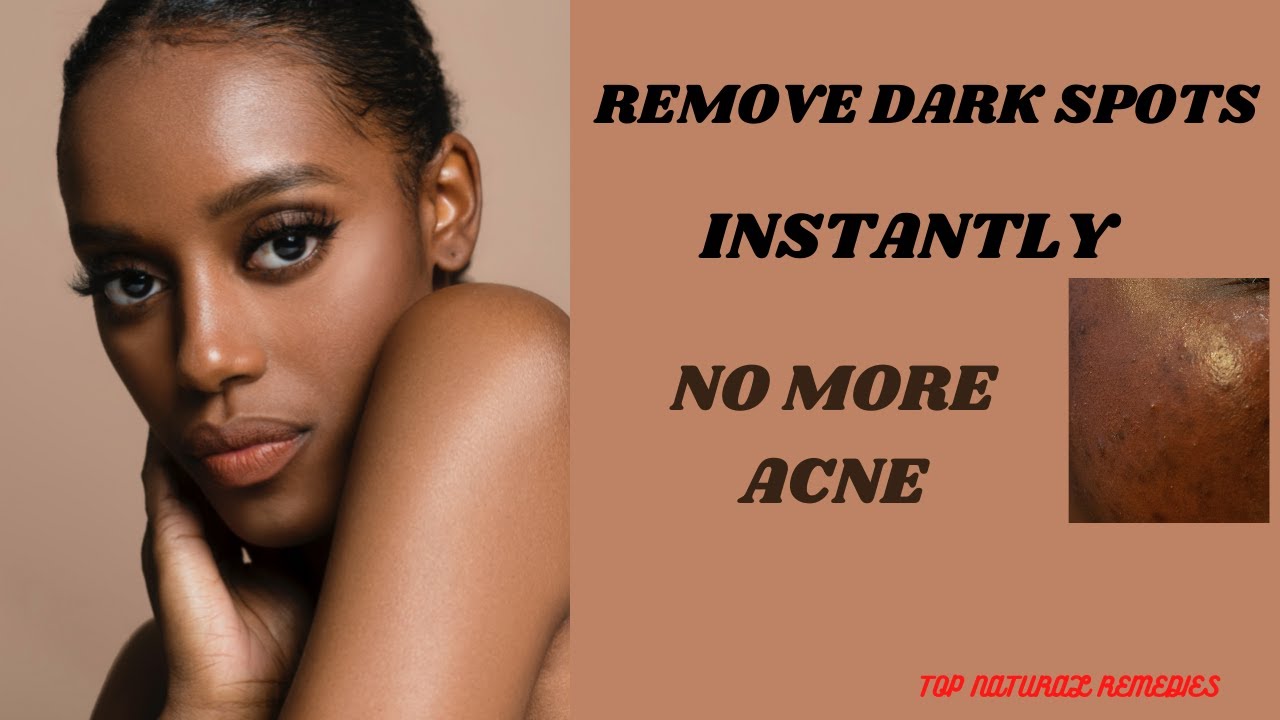 HOW TO GET RID OF ACNE SCARS AND DARK SPOTS IN JUST 7 DAYS - YouTube