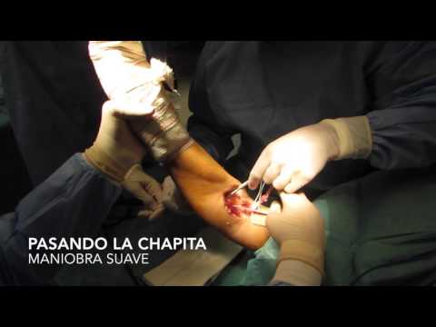 Reparacion de rotura BICEPS distal en codo (Dr Bernaldez)