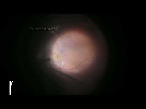 Retinal Cavernous Haemangioma
