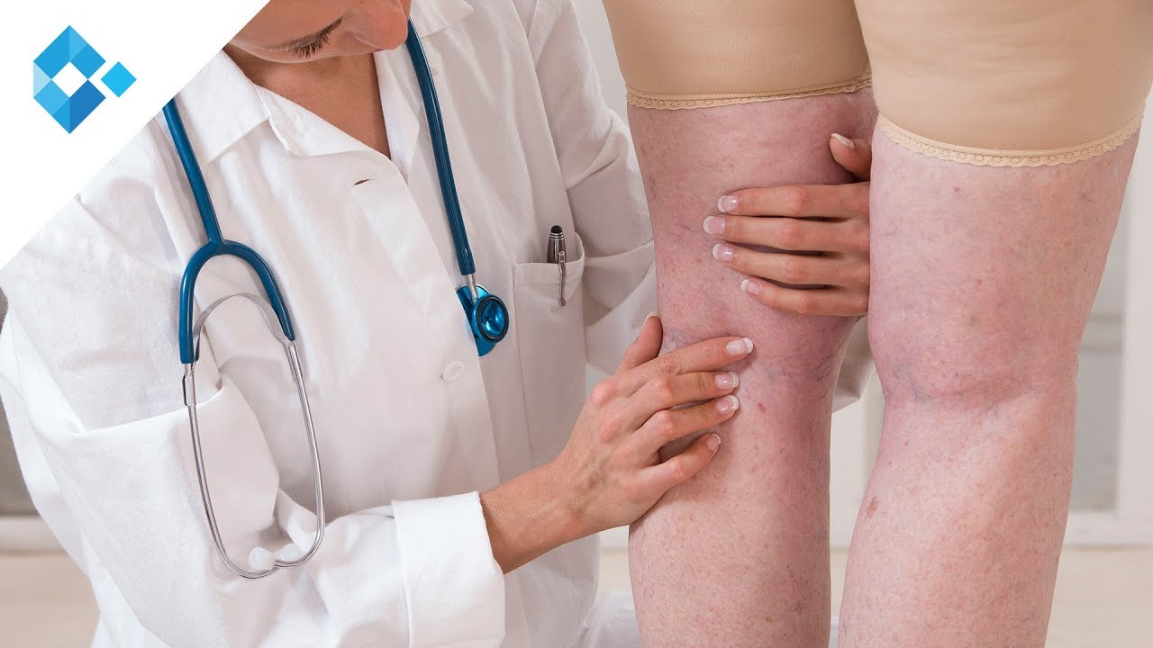 Krampfadern richtig behandeln | Dr. Werner (Facharzt für Dermatologie und Venerologie) - YouTube
