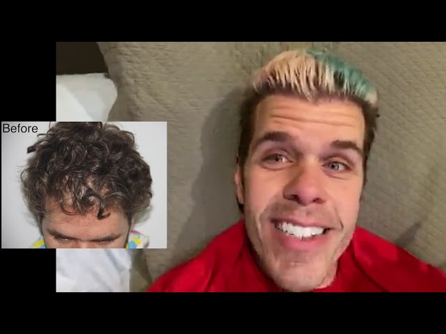 Perez Hilton Gives His Hair Transplant Update - 12 Months After Alvi Armani FUE Procedure