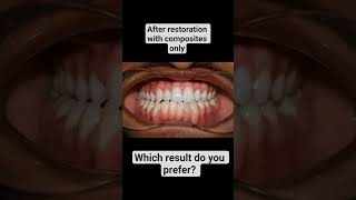 Severe Dental Caries Restored #fluoride #orthodontist #dentalcare