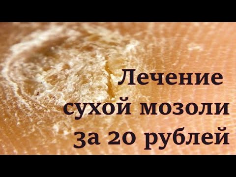 сухой мозоль, лечение сухого мозоля за 20 рублей