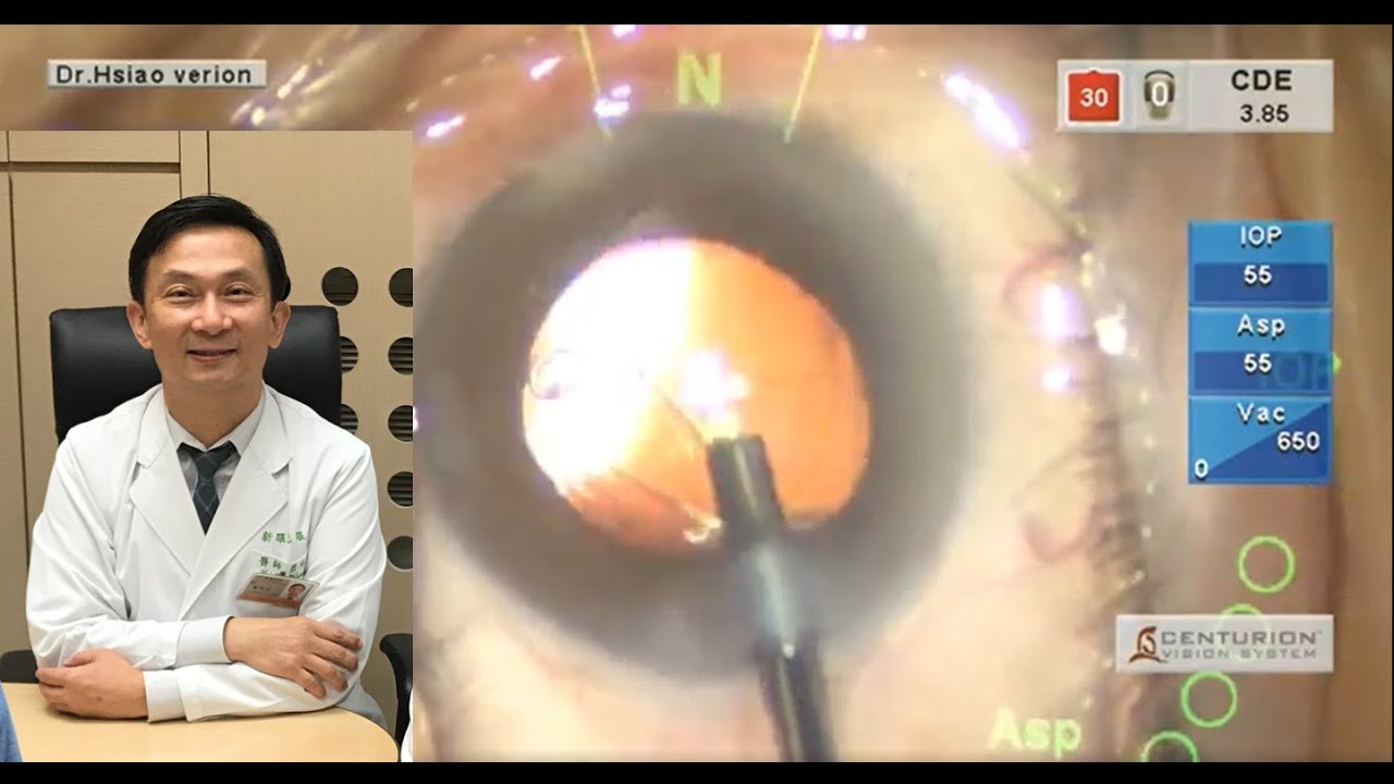 PDF) Effect of Co-Implantation of a Capsular Tension Ring on Clinical  Outcomes after Cataract Surgery with Monofocal Intraocular Lens Implantation